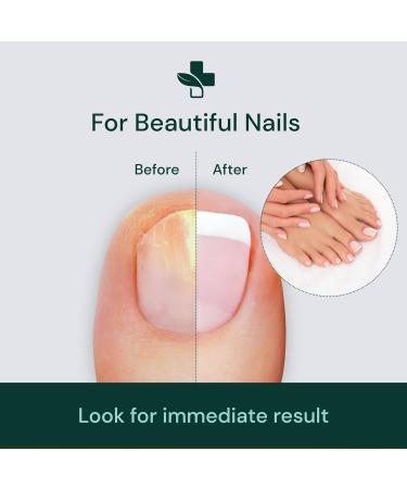 YogaMedic Fungal Nail Cure 10ml - Extra Strong, Patented Anti-Fungus Treatment for Toe Nails - Clinically Tested, Fast-Acting Formula - Buy Online on GoSupps.com