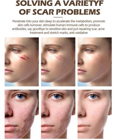 ulapithi Cream for scars 30 grams of natural smoothing beauty care cream for body scars for face body piercing teeth night day day and travel - Buy Online on GoSupps.com