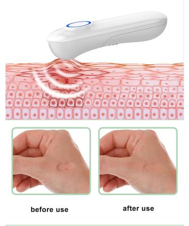 Insect bite Reliever Insect bite Treatment Non-Toxic Natural Relief of itching and Swelling Chemical-Free Treatment of Insect Bites Suitable for Camping Outdoor Sports Children Pregnant Women - Buy Online on GoSupps.com