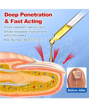 Buy Extra Strength Toenail Fungus Treatment - Fast Acting Nail Fungus Remover for Men & Women - 30mL Liquid Solution - Buy Online on GoSupps.com