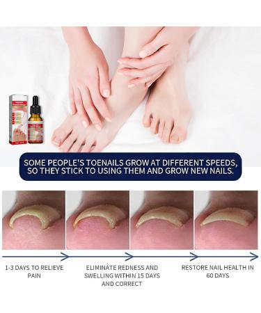 Ingrown Toenail Treatment Nail Growth Ingrowing Toenail Treatment Nail Helper Fungal Nail Treatment Correction Oil Drops Ingrown Toenail Corrector Toe Nail Fungus Treatment Cuticle Oil - Buy Online on GoSupps.com