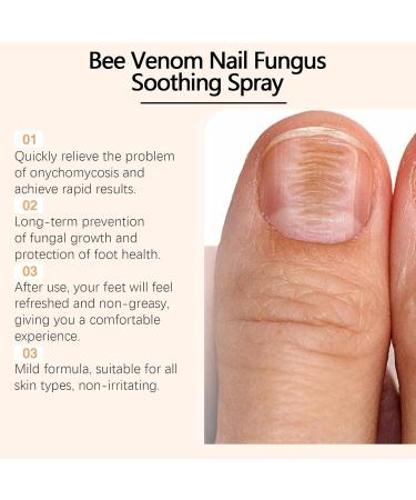 Bee Venom Nail Fungus Soothing Spray - Extra Strength Toenail Treatment (20ml) | Natural Nail Fungus Relief - Buy Online on GoSupps.com
