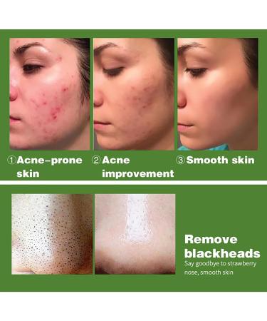 AILKE BOOST LUSTER AILKE AHA Acne Breakout Clearing Soap Bar Deep Clean Skin Unclog Pores Brightening with Lavender Essential Oil Reduces Pimples Blackheads 150 g Pack of 1 1 copy - Buy Online on GoSupps.com