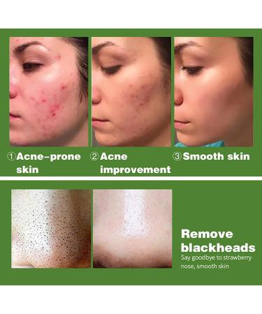 AILKE Salicylic Acid Acne Removal Face Care Set Effectively Anti Acne-prone Skin Control Breakouts Reduce Pimples Unclog Pores Repair Damaged Skin Natural & Paraben Free - Buy Online on GoSupps.com