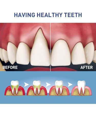 Rubber Treatment Gel for Gums Therapy - Instant Relief & Prevention of Gum Inflammation | 5 PCs - Buy Online on GoSupps.com