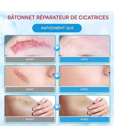 Anti-Scar Cream Light Non-Sticky Nourishing 20g Body Cream Butter Stick for Scars Burn For Hands Legs Knees Neck Burn Buttons Women Face Body - Buy Online on GoSupps.com