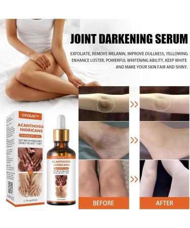 Skin Bleaching Serums | Dark Skin Permanent Whitening Lightening | Armpit Bleaching Serums for Women Supercharged Face Serums Skin Lightening Bleaching Oil Black Spot Corrector Remover for Face 2Pcs - Buy Online on GoSupps.com