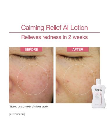 Physiogel Calming Relief A.I. Face Lotion | Soothes Sensitive, Eczema-Prone Skin | Hypoallergenic Formula, 6.7 fl. Oz - Buy Online on GoSupps.com