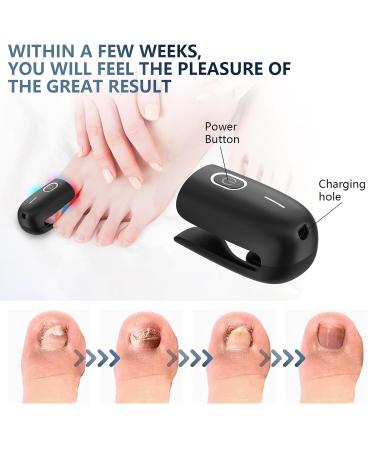 Ikeen Nail Fungus Treatment Device - Effective Onychomycosis Relief with Red & Blue Light Painless & Fast Fuzspilz Solution for Healthy Nails - Buy Online on GoSupps.com