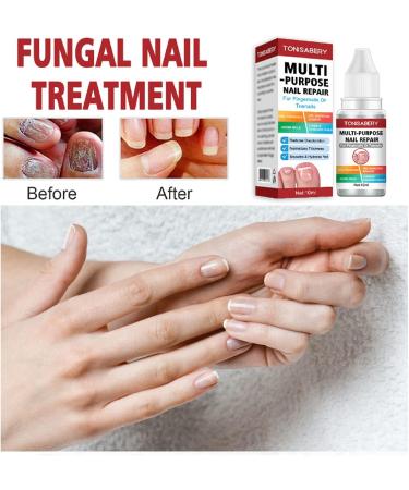 Extra Strong Fungal Nail Treatment - Repair, Strengthen, and Renew Damaged Toenails and Fingernails - Buy Online on GoSupps.com