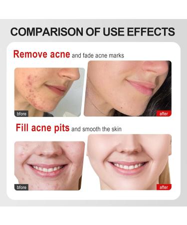 Waymaytecy 25g antiblemish gel for face antipimple gel oil control and hydration lighten acne spots and pimples suitable for men and women white - Buy Online on GoSupps.com