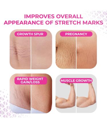 LURE Essentials Fade Stretch Marks Cream with Cocoa Butter - Pregnancy Stretch Mark Remover & Prevention - Buy Online on GoSupps.com