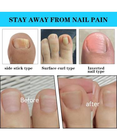 Buy 50+1 Pcs Ingrown Toenail Treatment Kit - Professional Pain-Free Correction & Removal Set for Men & Women - Buy Online on GoSupps.com