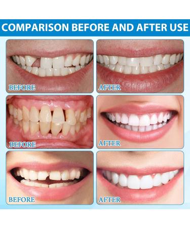 Temporary Tooth Filling Tooth Repair Kit with Tweezers DIY Temporary Tooth Repair Beads Teeth Replacement for Temporary Restoration of Missing & Broken Teeth Replacement Dentures 30ml - Buy Online on GoSupps.com