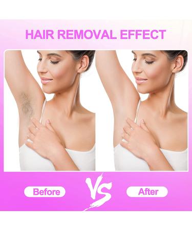 IPL Laser Hair Removal Device | At-Home Permanent Painless Hair Removal | 999,900 Flashes | For Women and Men | Facial, Armpits, Whole Body - Buy Online on GoSupps.com
