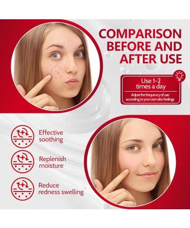 25g Gel-Anti-Boutons Gel Facial Anti-Boutons Gels Pour Imperfections Du Visage Soins Pour le Visage Hydrate la Peau Convient Aussi Bien Aux Hommes Qu'aux Femmes - Buy Online on GoSupps.com