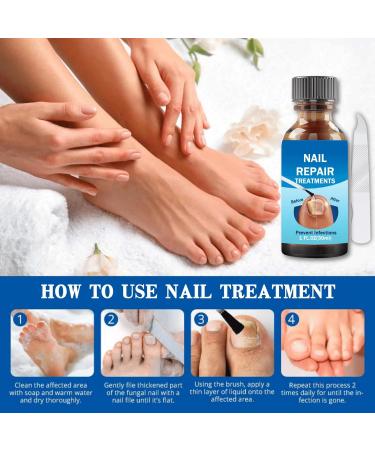 Fungal Nail Treatment 30ML Nail Fungus Serum for Toenail Extra Strong Gentle Anti Fungal Nail Serum Protects Thick Broken Discolored Nails Restoring Healthy Nails For Finger And Toe Nail Fungal - Buy Online on GoSupps.com