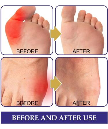 10pcs Herbal Extract Bunion Relief Patches for Men and Women - Foot Care Pain Relief for Bunion Swelling and Soreness - Buy Online on GoSupps.com