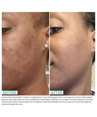 Urban Skin Rx Acne & Blemish Control Mask | Dual-Action Formula with Sulfur, Salicylic Acid & Niacinamide | 2.5 Oz - Buy Online on GoSupps.com