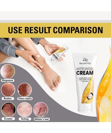 Antifungal Cream for Athletes Foot, Ringworm & Jock Itch - Anti Fungal Skin Treatment for Adults - Sensitive Skin Formula - Buy Online on GoSupps.com