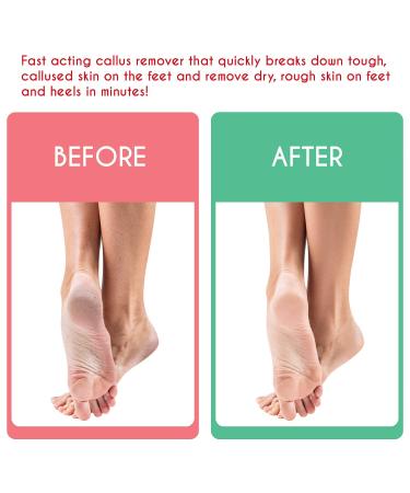 Tachibelle Callus Remover ULTRA Scent - Professional Strength for Feet - 2 Bottles - Buy Online on GoSupps.com