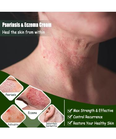 All-Natural Eczema & Psoriasis Cream for Sensitive Skin | Herbal Anti-Itch Lotion for Dermatitis, Shingles, Acne & Rosacea | Soothing Moisturizer for Dry, Itchy Skin (1.06oz & 5.50oz Options) - Buy Online on GoSupps.com