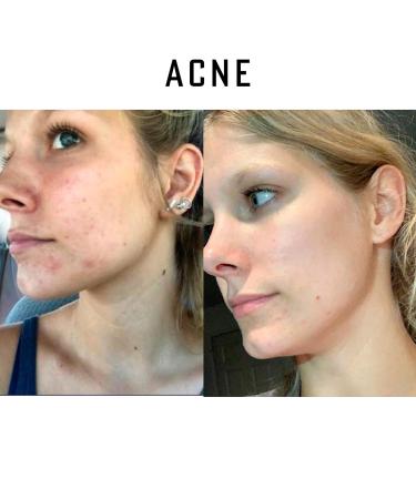 Buy Pure Organic Ozonated Olive Oil Extra Strength 1200 - Acne Anti-Aging Rosacea Treatment for Sensitive Skin - Made in Spain - Buy Online on GoSupps.com