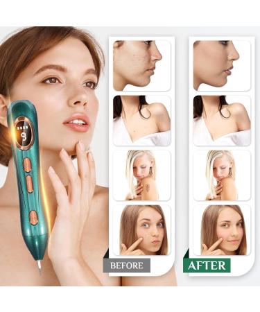 Augot Skin Tags Removal Pen Professional Mole Remover Pen kit Portable USB Rechargeable Skin Tag Removal Pen with 9 Modes LCD Display Replaceable Needles for Wart Freckle (Dark Green) - Buy Online on GoSupps.com