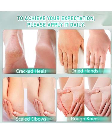 40% Urea Foot Cream With 2% Acid Urea Cream 40 Percent For Feet Aloe Vera & Hyaluronic Acid Foot Cream For Cracked Heels And Dry Skin Foot Moisturiser Foot Cream For Hard Skin Moisturizing 150g - Buy Online on GoSupps.com