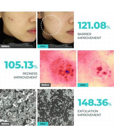 Buy 9 Wishes Dermatic Clear Toner - Mild Exfoliating Acne Treatment 5.07 fl. oz | Best Face Toner for Clear Skin - Buy Online on GoSupps.com