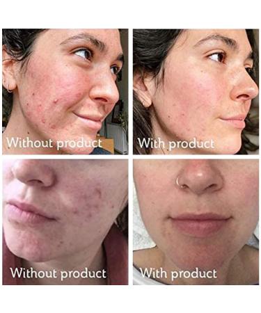 Science of Skin Rescue No. One - Ultimate Treatment for Spots Blemishes & Acne Scars | International Shipping Available - Buy Online on GoSupps.com