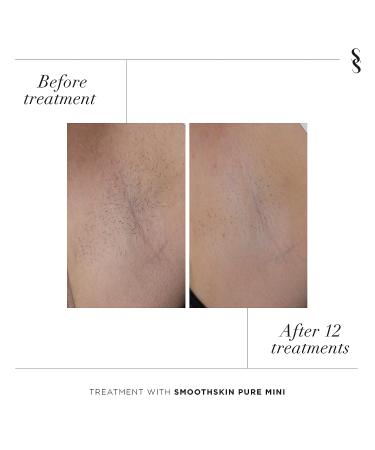 SmoothSkin Pure Mini IPL Hair Removal Device - FDA Cleared for Women & Men - Body & Face - Buy Online on GoSupps.com