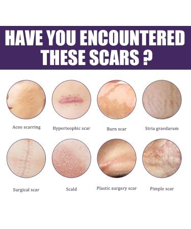 Silicone Fade Stretch Marks and Scars Improving Facial Skin - One Size - Buy Online on GoSupps.com