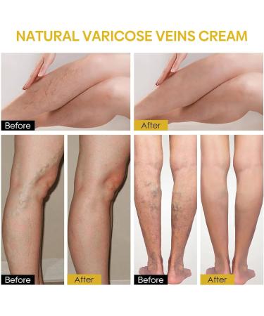 2024 New Bee Venom Varicose & Spider Veins Relief Cream for Legs Natural Varicose & Spider Veins Improve the Look of the Legs and Blood Circulation Tired and Heavy Legs Relief 60g/2.11fl.oz (3 Jars) - Buy Online on GoSupps.com