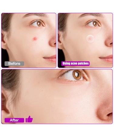 Hydrocolloid Acne Patches - 72 Count Waterproof Spot Stickers for Zits & Blemishes | Invisible Skin Care Solution - Buy Online on GoSupps.com