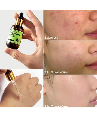 Rosarden Anti Acne Serum for Face Natural Herbal Face Serum for Improvement Pimples Pore Acne Scar Anti Pimple Serum Face Care for All Skin Types of Acne - Buy Online on GoSupps.com