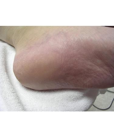 Footlogix Cracked Heel Formula 125ml - Best Treatment for Dry Cracked Heels | International Shipping Available - Buy Online on GoSupps.com