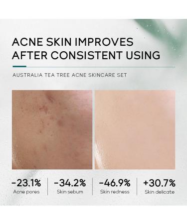 Tea Tree Skin Care Set Gift for Teen Girls Including Cleanser Toner Serum Face Cream Acne Gel Skin Care Set - Buy Online on GoSupps.com