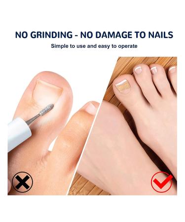 Toenail Correction Patch 100PCS - Professional Ingrown Toenail Corrector Strips for Foot Care - Health Toenail Treatment Tool for Glue-Free Nail Correction - Blue - Buy Online on GoSupps.com
