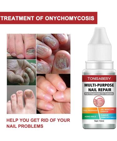 Toenail Repair Solution Extra Strong Finger and Toenail Repair Fluid 10 ml nail repair serums for toenail or fingernail repair and renew nail damage Yunmiao - Buy Online on GoSupps.com