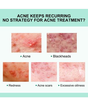 Anti-Acne Face Cream Spot Cream for Acne Treatment and Spot Treatment Skin Treatment Gel Cream For Face Blemishes & Blackheads Acne Treatment Cream Anti Acne Spot - Buy Online on GoSupps.com
