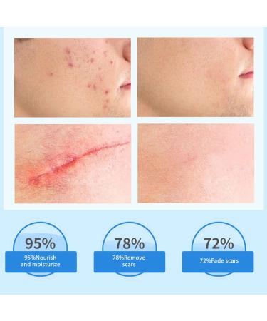 Scar Removal Ointment Gel - Herbal Cream for Old & New Scars, Stretch Marks, Surgery Injuries, Burns & Acne Treatment 1.1oz - Buy Online on GoSupps.com