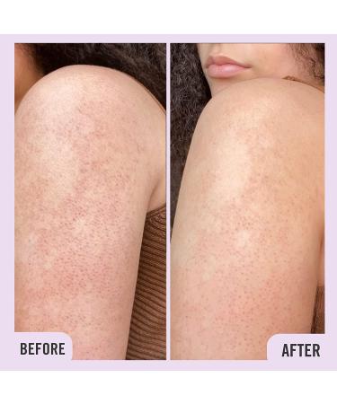 First Aid Beauty KP Bump Eraser Body Scrub Exfoliant 8 oz - 10% AHA for Keratosis Pilaris - Buy Online on GoSupps.com