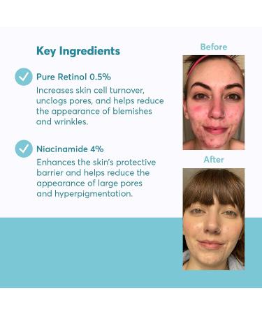 MDacne Retinol 0.5% and Niacinamide 4% Cream - Blemish Reduction & Improved Skin Texture - Buy Online on GoSupps.com