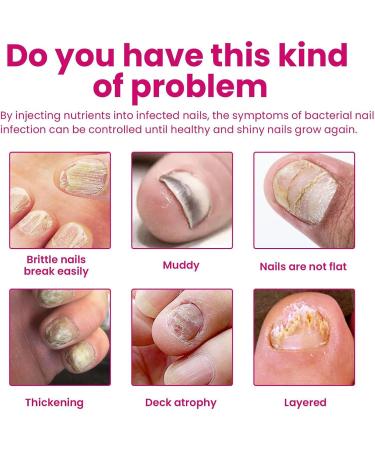  G n rique Strengthener For Damaged Nails - 10ml Reinforced Foot Nail Care | Effective Natural Cuticle Repair Care | Yellow Foot And Nail Care For Feet And Hands - Men - Buy Online on GoSupps.com