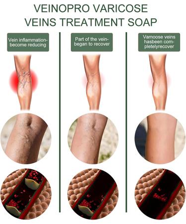 Varicose Veins Soap - Natural Wormwood Formula for Spider Veins & Leg Healing (2PCS) - Buy Online on GoSupps.com