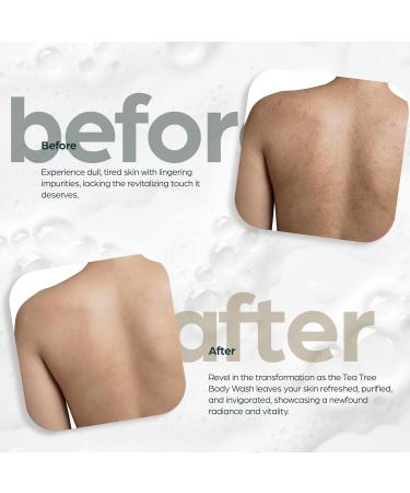 Artnaturals Antibacterial Tea Tree Oil Body Wash For Men & Women Remedy Soap Extra Strength - Helps Treat Acne, Athletes foot, Eczema, Toenail Fungus & Jock Itch & Ringworm (16 Fl Oz (Pack of 2) - Buy Online on GoSupps.com