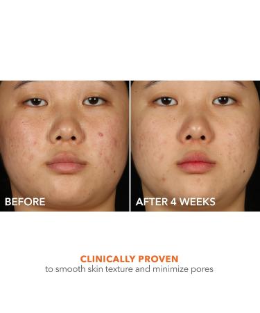 Dr Dennis Gross Alpha Beta 2% BHA+ Breakout Solution - Minimize Pores & Prevent Breakouts - 5 Fl Oz | International Shipping Available - Buy Online on GoSupps.com