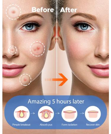 LitBear Acne Pimple Patches - Day and Night Set | 180 Dots with Witch Hazel, Tea Tree & Calendula Oil | Extra Adhesion for Face | Zit Patch AM + PM - Buy Online on GoSupps.com