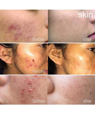 Kidskin Three-Step Acne Treatment Kit for Kids, Tweens, Teens - Face Wash, Serum, Moisturizer - Breakout Prevention for Boys & Girls - Made in USA - Buy Online on GoSupps.com